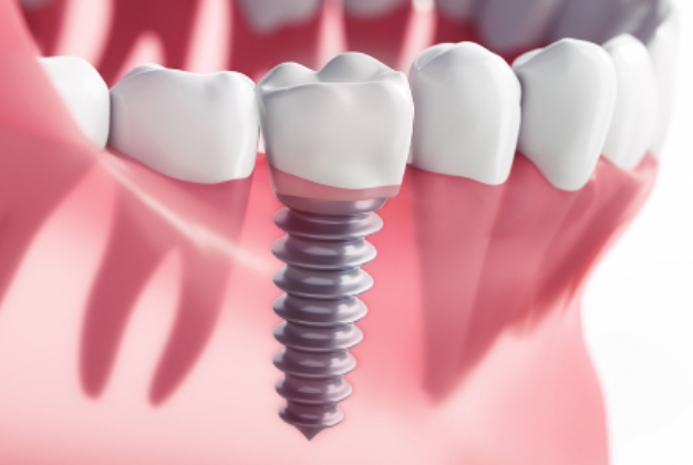 インプラントの料金を知りたい方