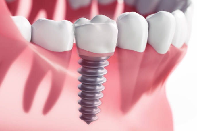 インプラントの料金を知りたい方