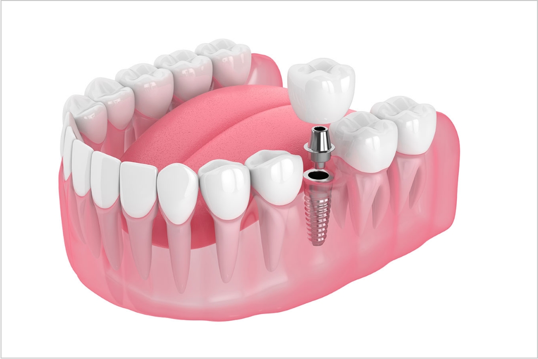 インプラントの費用・値段