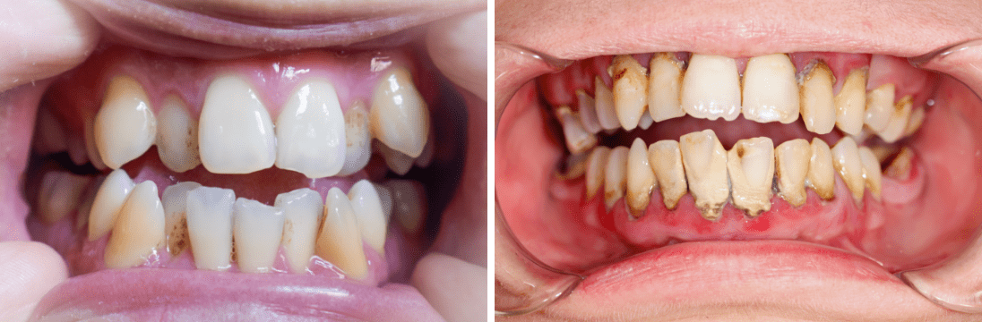 歯並びの悪さが与える影響