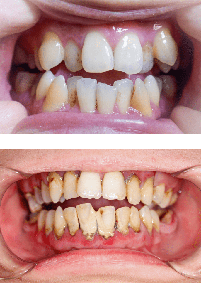 歯並びの悪さが与える影響