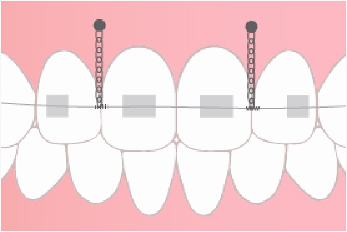 ガミースマイル