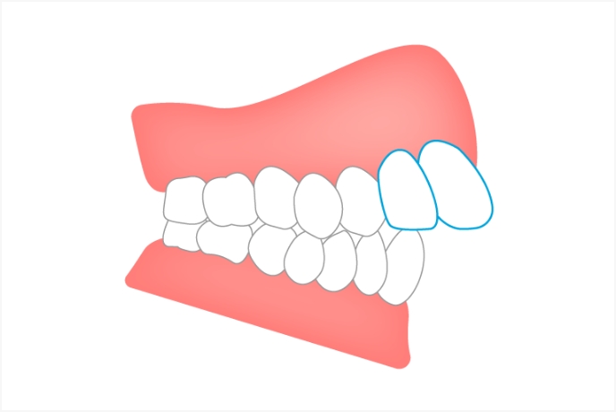 出っ歯・口ゴボ