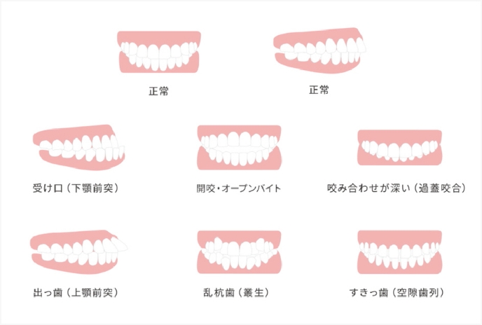 軽度から重度の様々な歯並びに対応