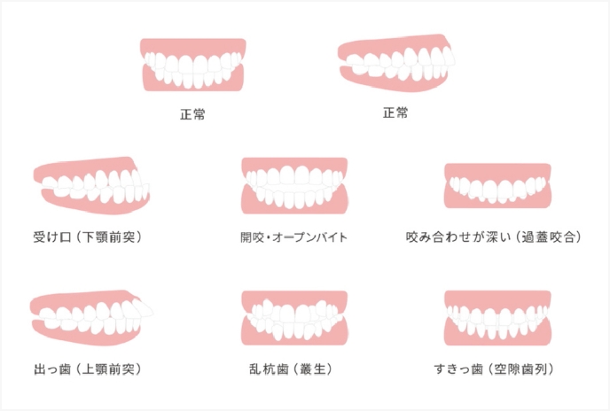 軽度から重度の様々な歯並びに対応