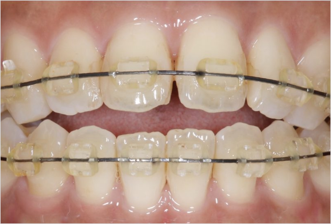 GUMMETAL矯正（両顎：小臼歯非抜歯）