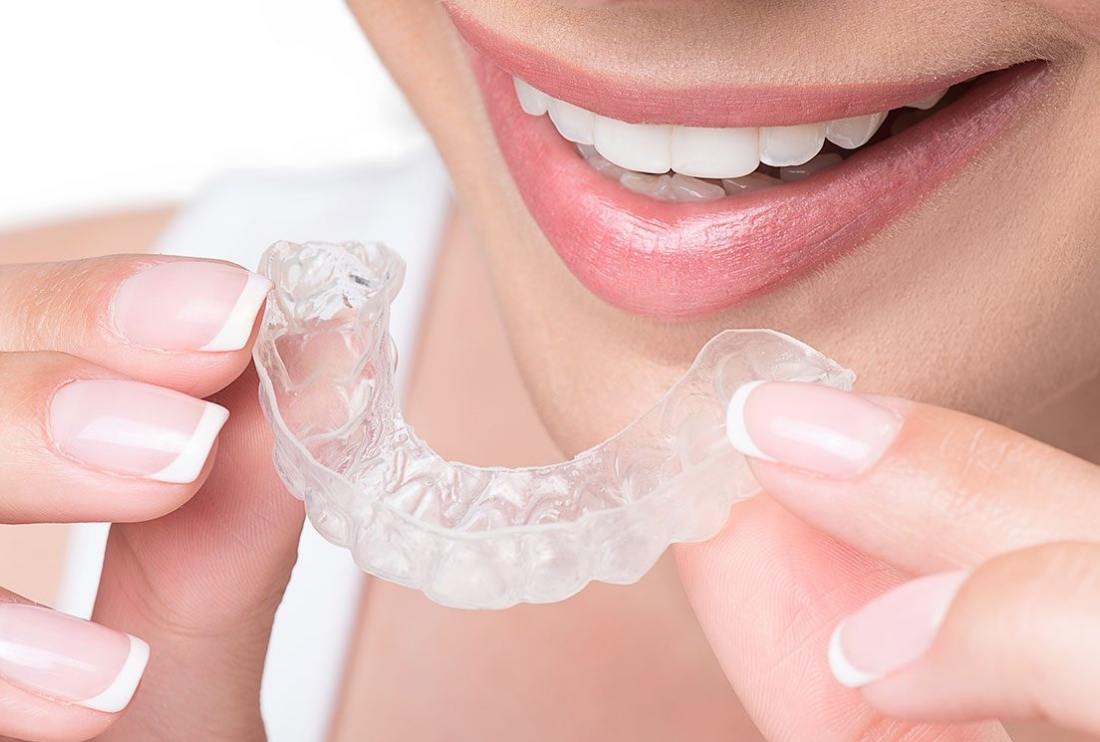 インビザラインgo（マウスピース矯正・両顎）