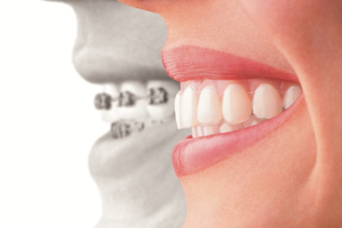 歯列矯正の費用・値段