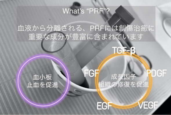 自己血由来の血小板PRFによる骨組織の再生と修復