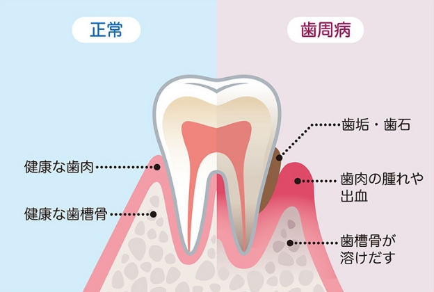 歯周病の予防