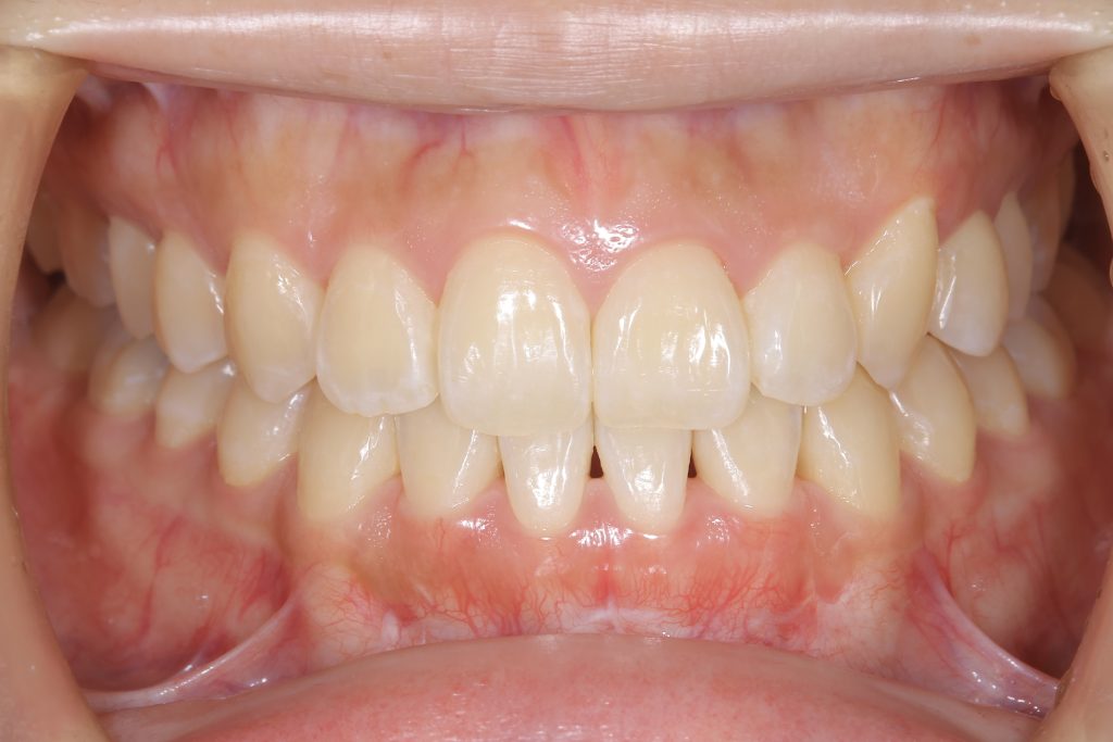 矯正治療終了後の正面