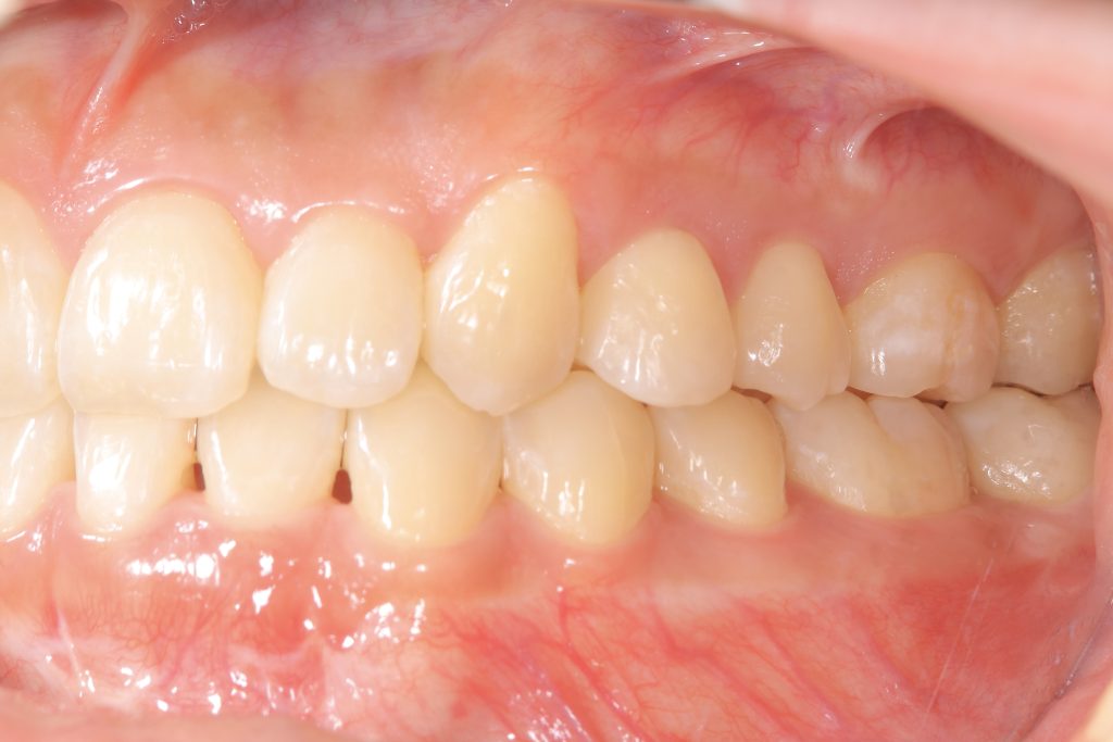 矯正治療終了後の左側方面