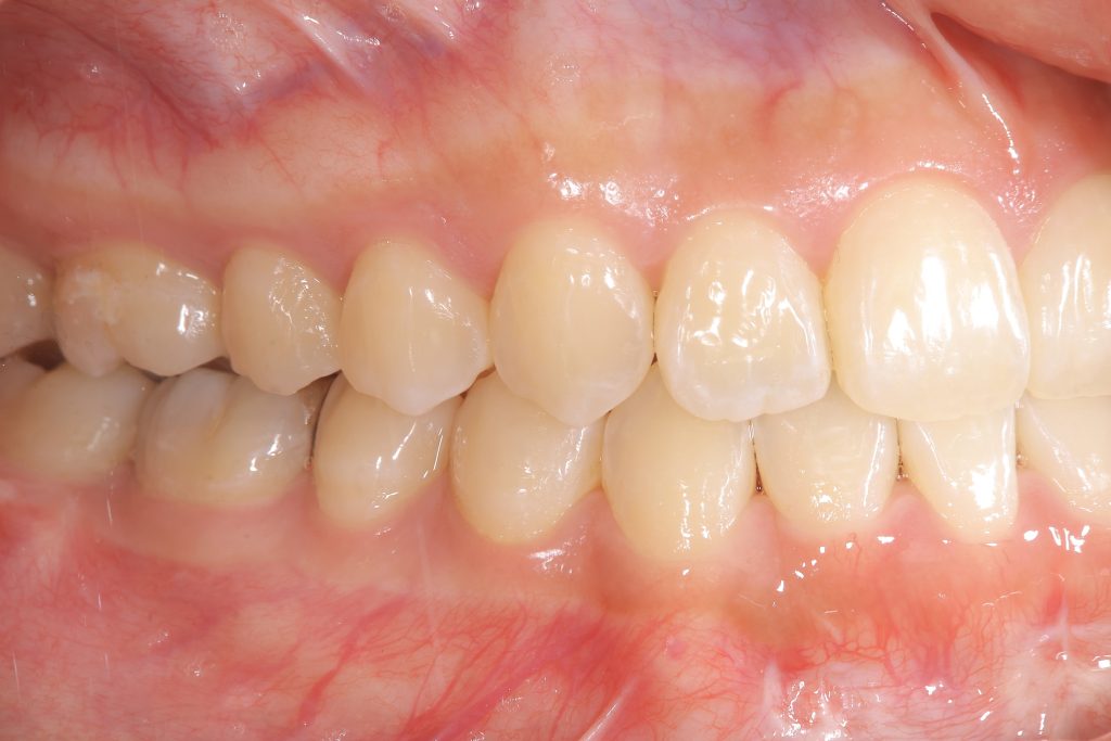 矯正治療終了後の右側方面