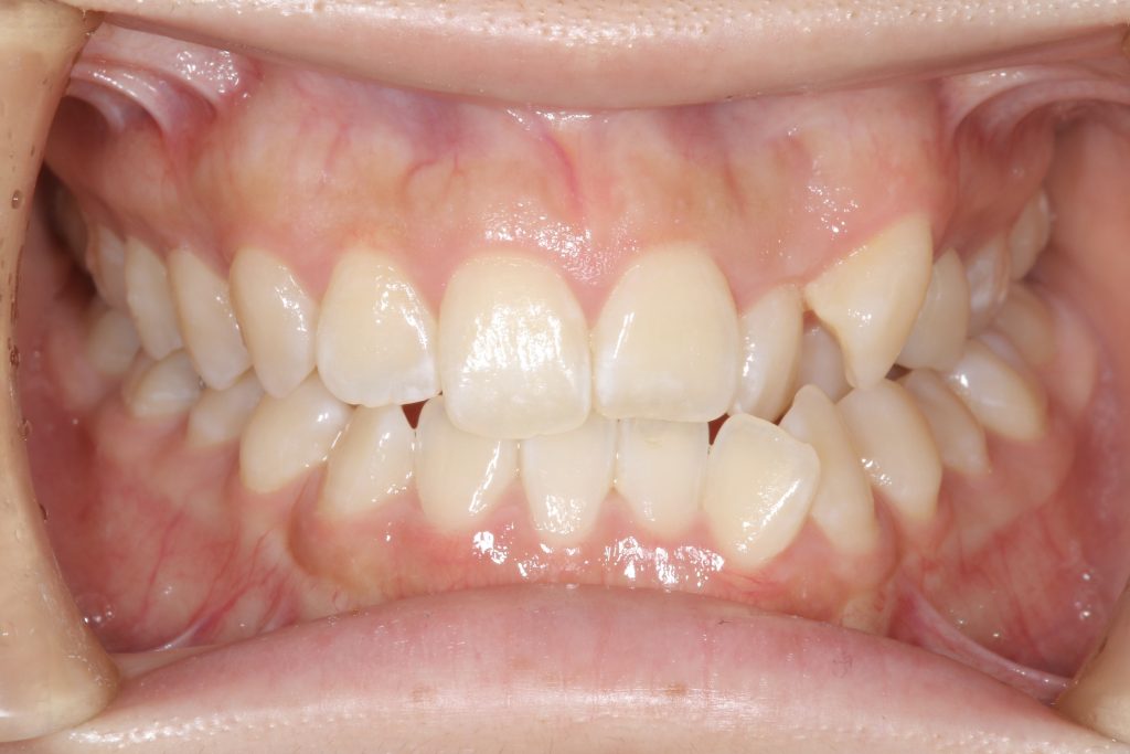 矯正治療前の口腔内写真