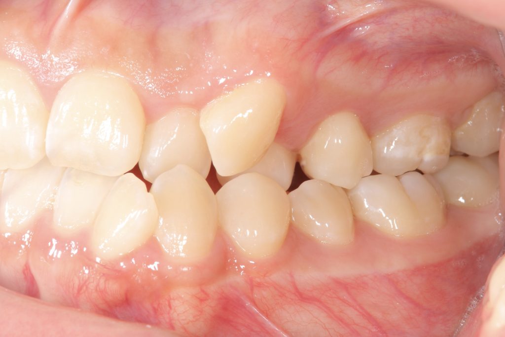 矯正治療前の口腔内写真
