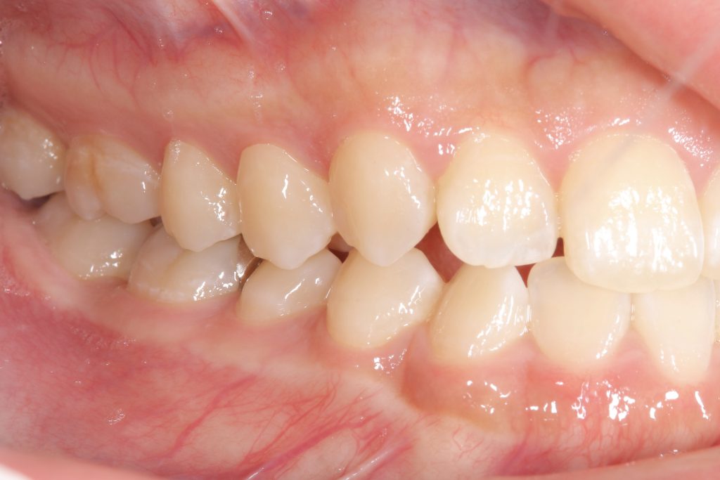 矯正治療前の口腔内写真
