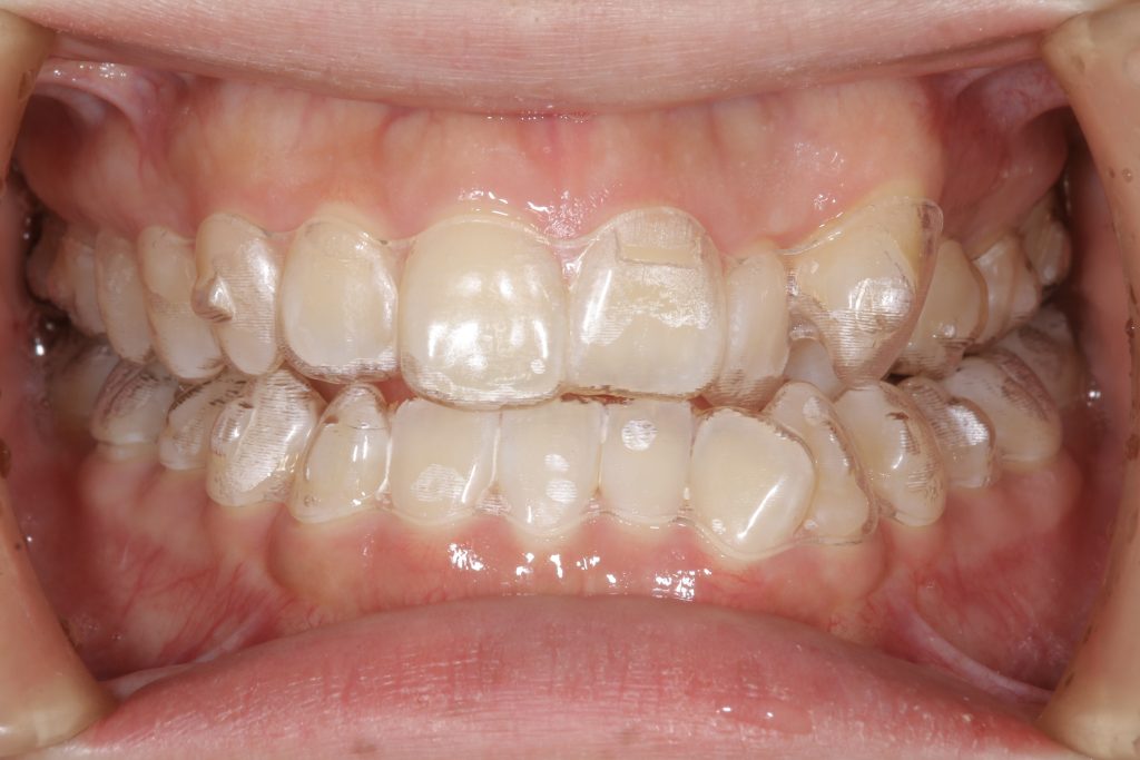 アライナー矯正中の正面写真