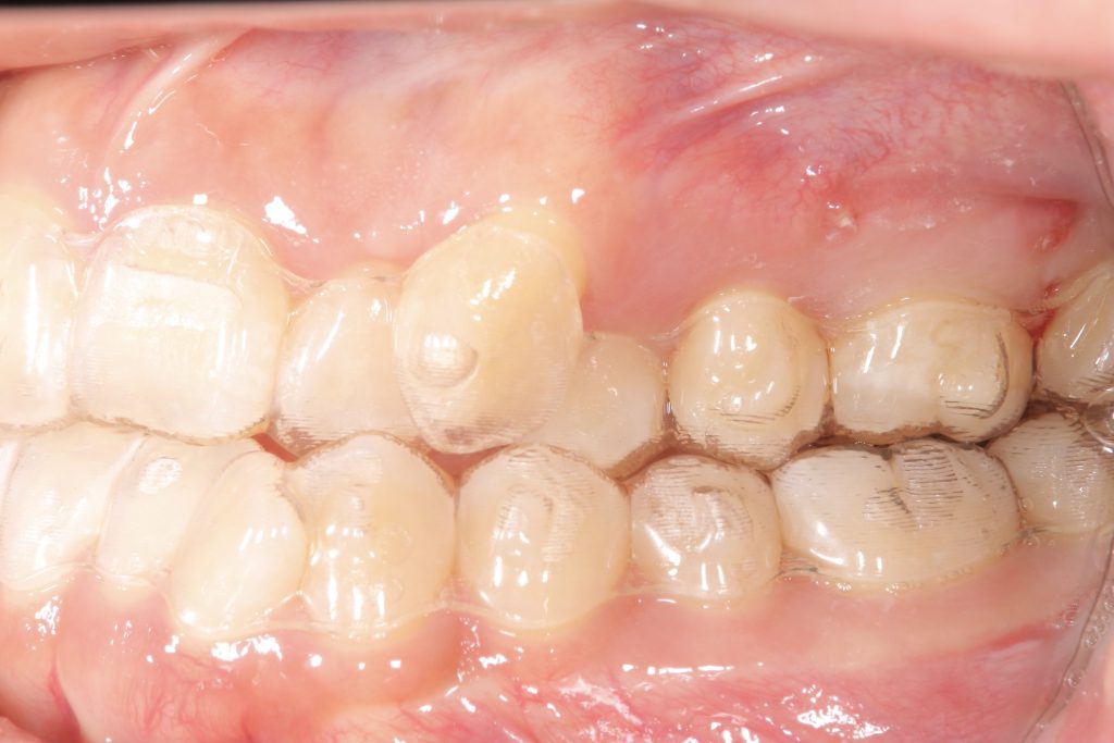 アライナー矯正中の左側方写真