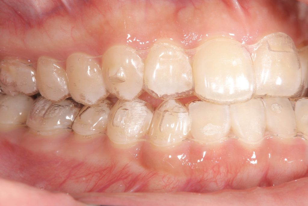 アライナー矯正中の右側方写真