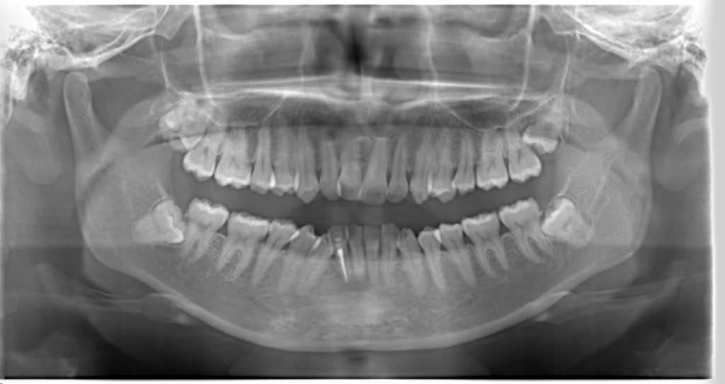 叢生・ガタガタ・非抜歯・矯正治療前パノラマ写真