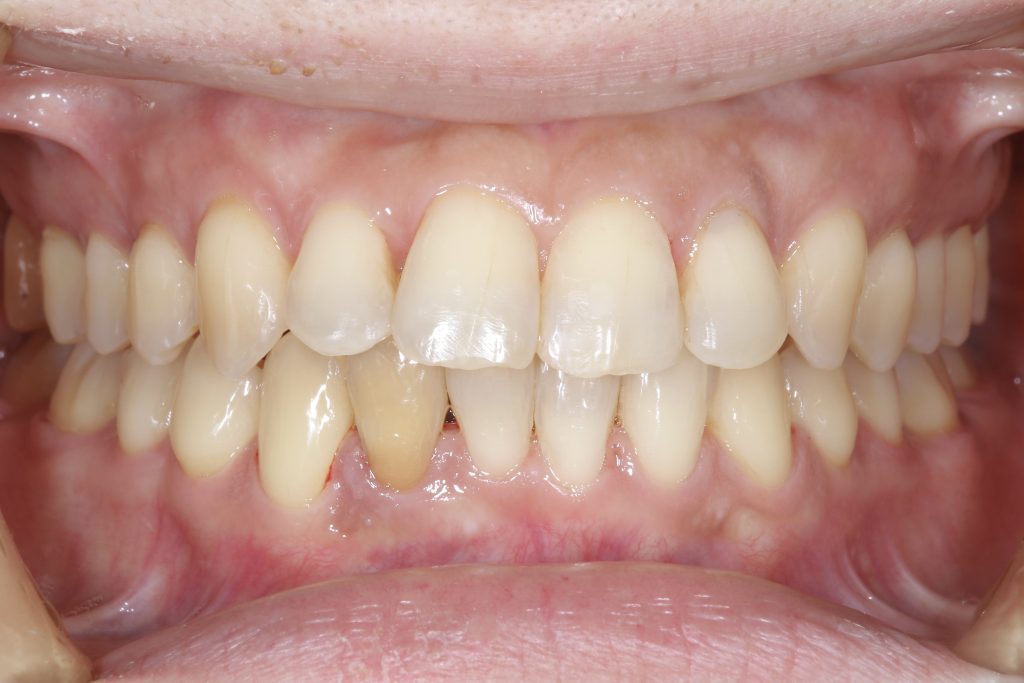 叢生・ガタガタ・非抜歯・矯正治療後正面写真