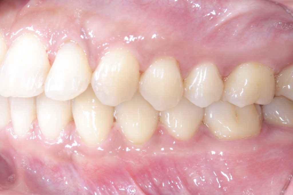 叢生・ガタガタ・非抜歯・矯正治療後左側面写真