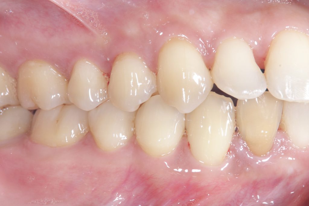 叢生・ガタガタ・非抜歯・矯正治療後右側面写真