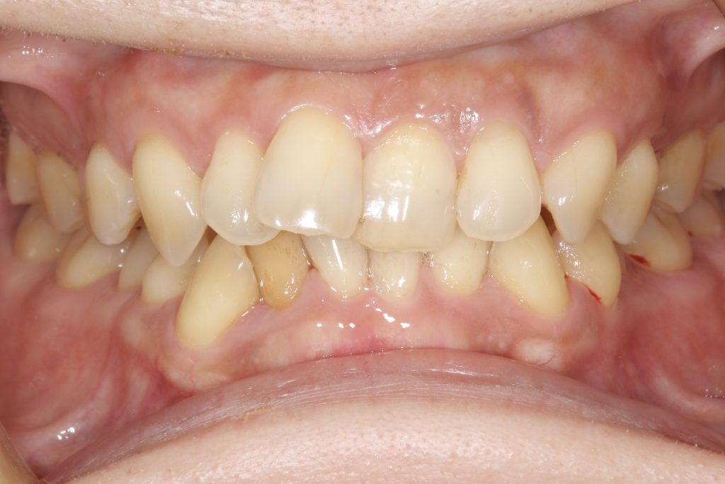 叢生・ガタガタ・非抜歯・矯正治療前正面写真