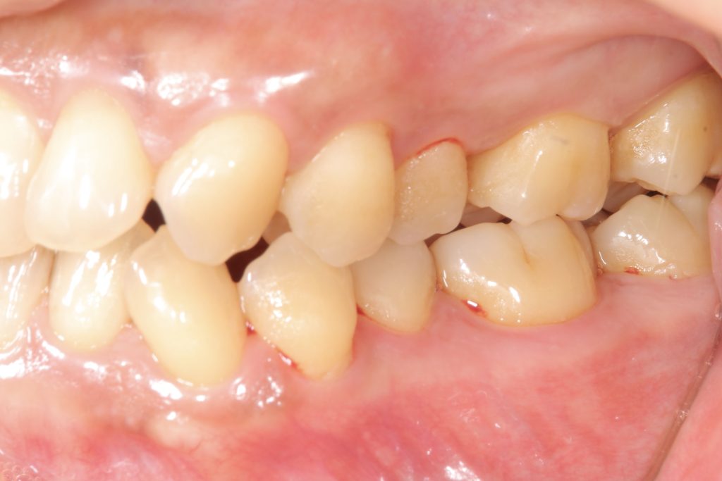 叢生・ガタガタ・非抜歯・矯正治療前左側面写真