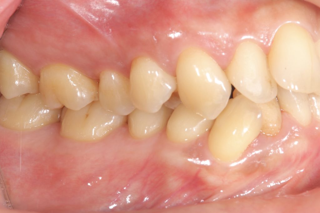 叢生・ガタガタ・非抜歯・矯正治療前右側面写真
