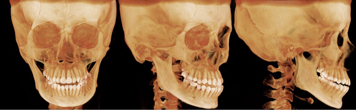 矯正治療前の3DCT写真