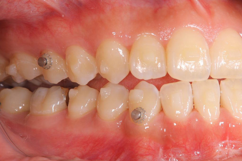 アライナー矯正中右側方面