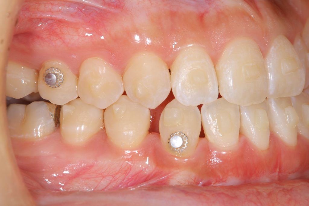 アライナー矯正中の右側方面２