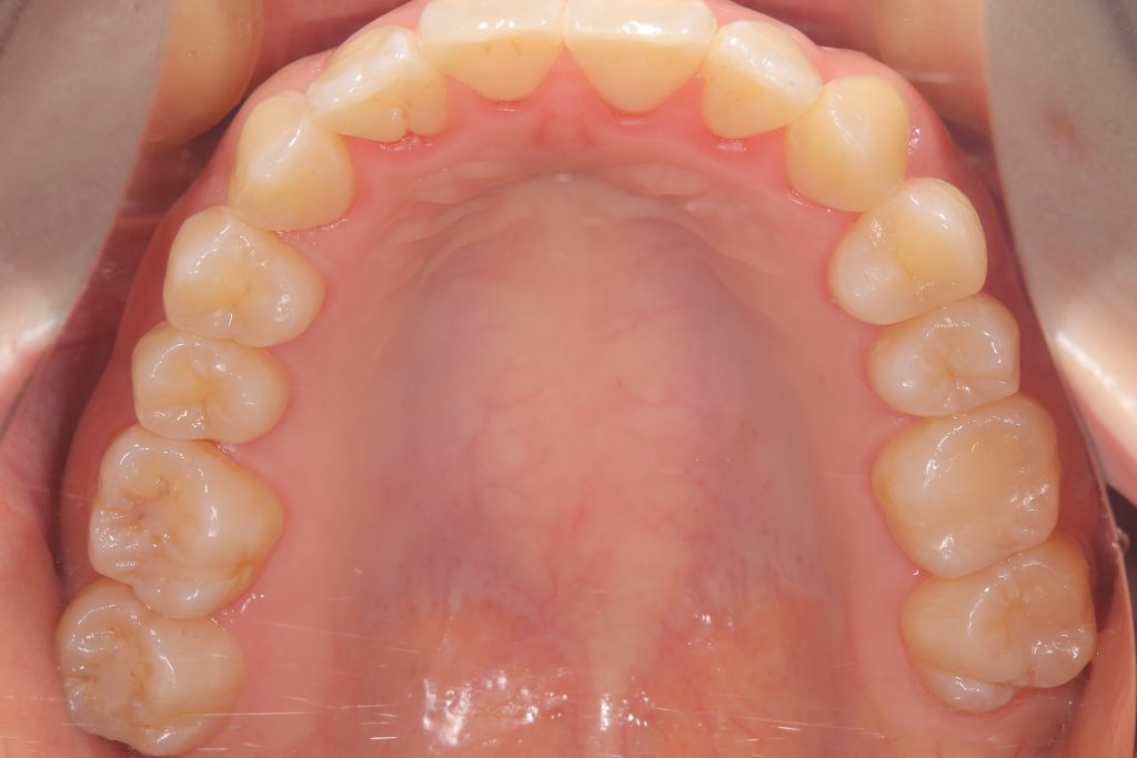矯正終了後の咬合面