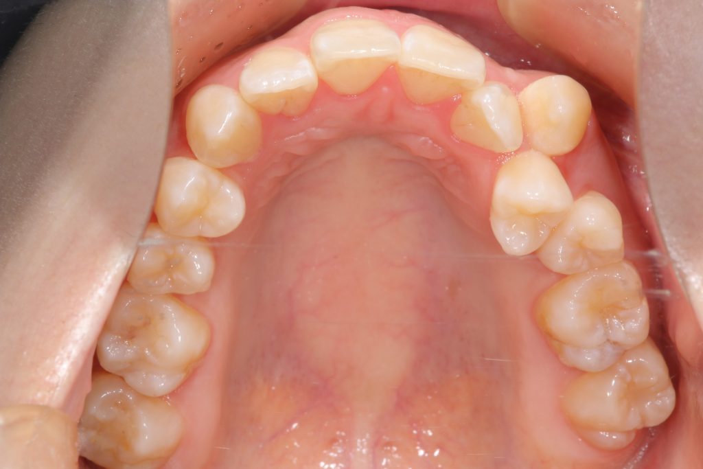 矯正治療前の上顎咬合面