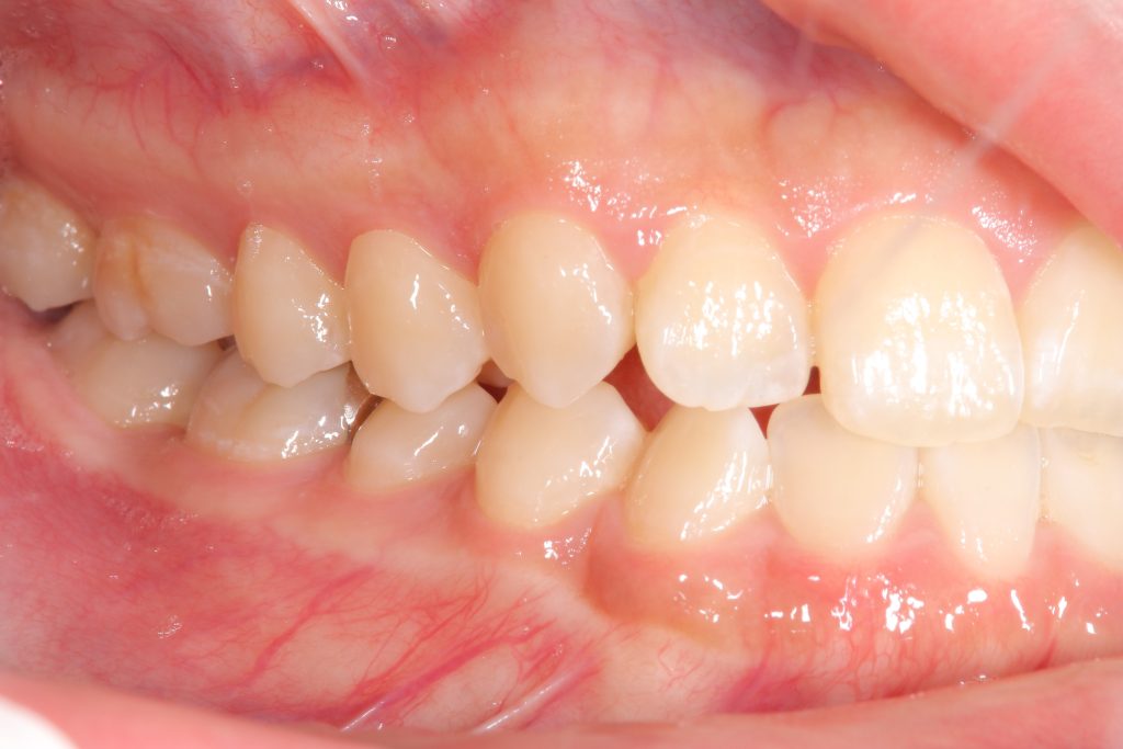 矯正治療前の右側方面