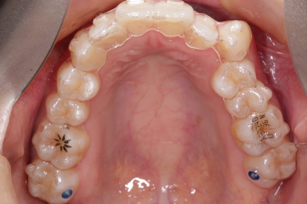 アライナー矯正中の上顎咬合面
