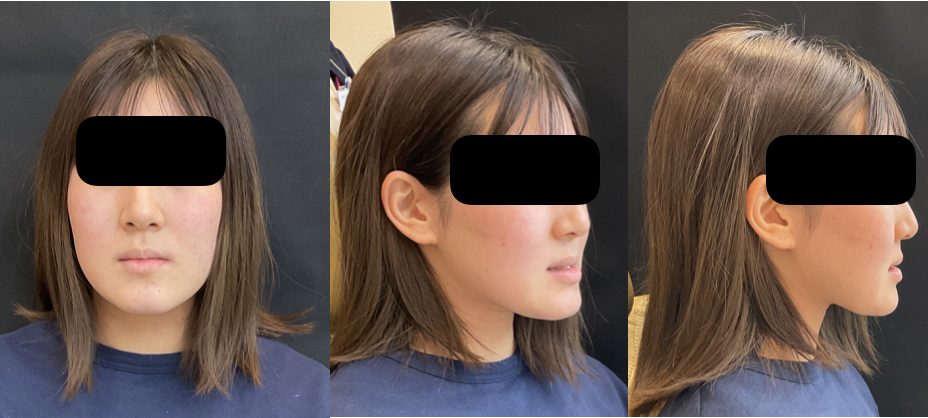 矯正治療前の顔貌