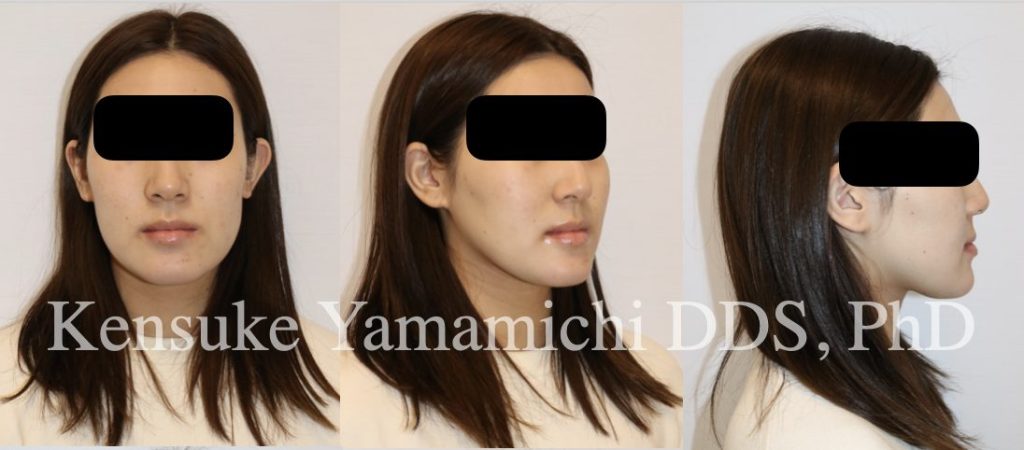 矯正治療後の顔貌