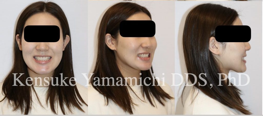 矯正治療後の顔貌スマイル時