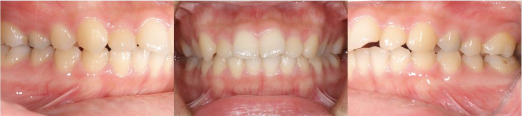 リンガル矯正前の正面観