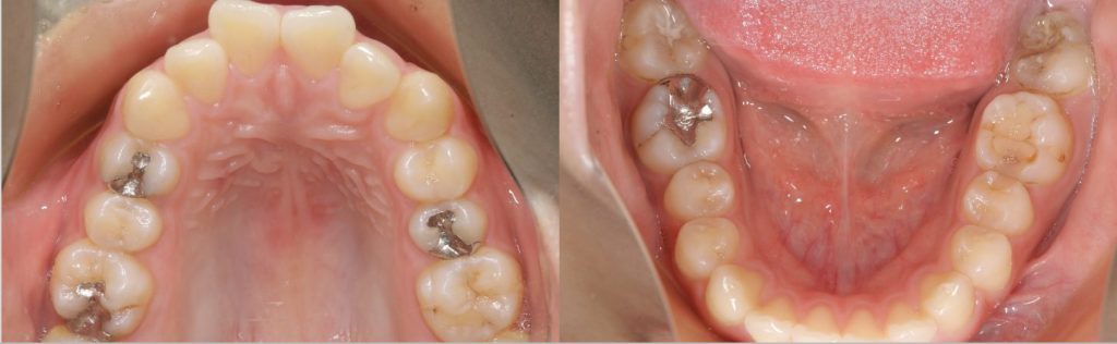 リンガル矯正前の咬合面観