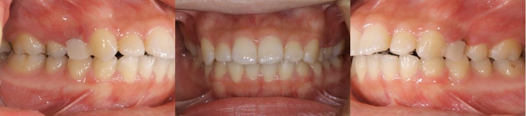 リンガル矯正中の正面観