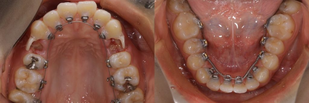 リンガル矯正中の咬合面観