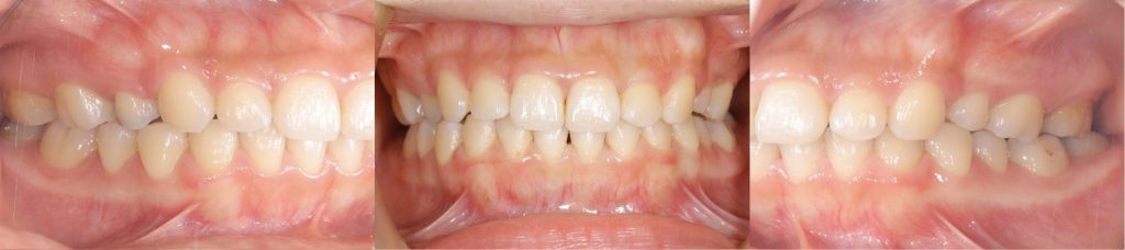 リンガル矯正後の正面観