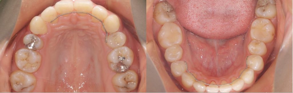 リンガル矯正後の咬合面観